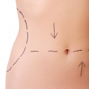 EXTENDED TUMMY TUCK